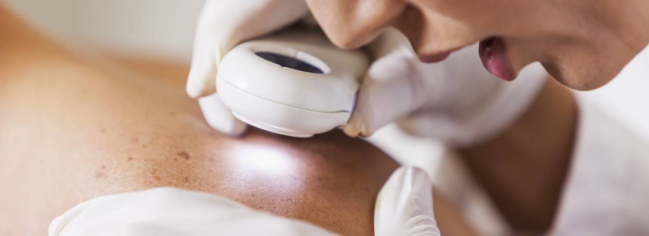 Prévenir le cancer de la peau